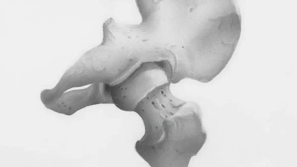 2. Hip Osteoarthritis
