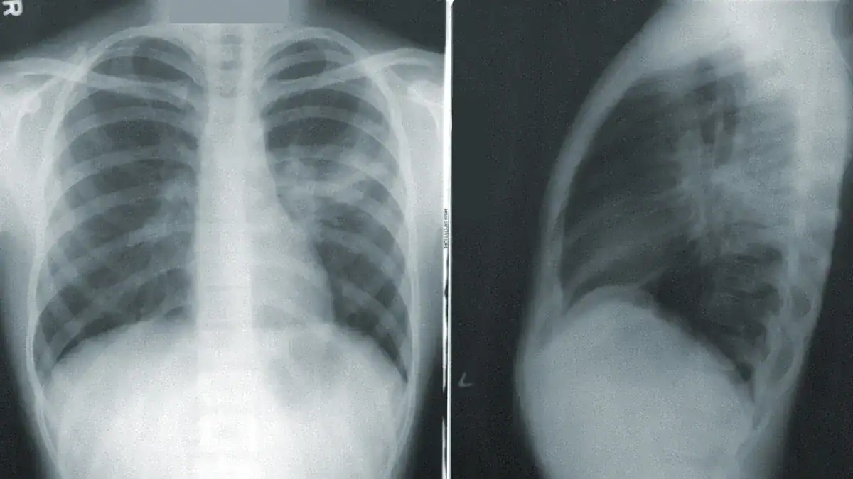 Diagnosing Fluid in Lungs