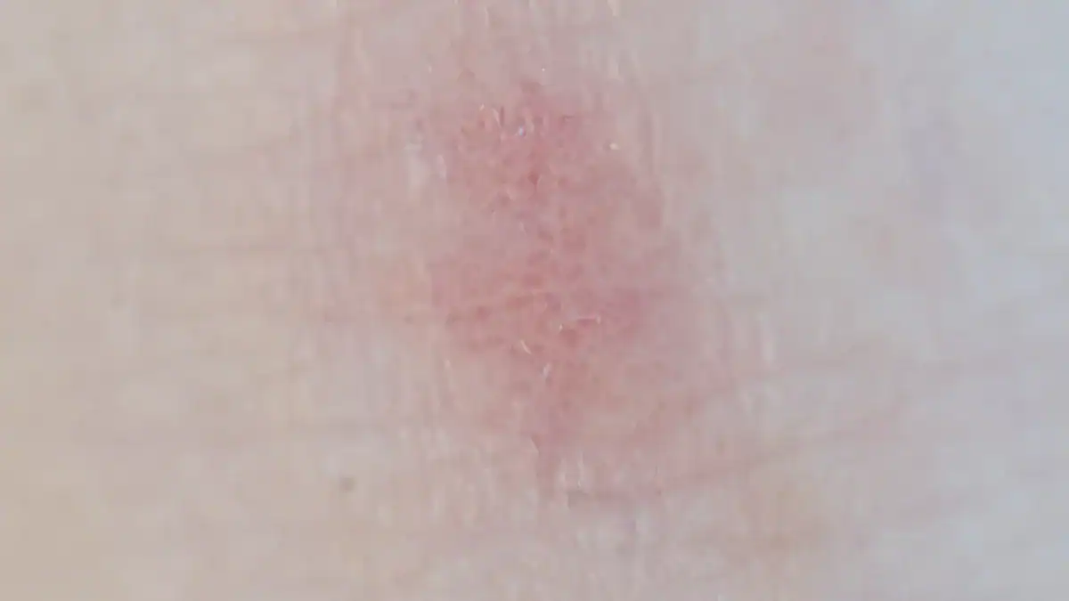 When to Worry About a Shin Lump