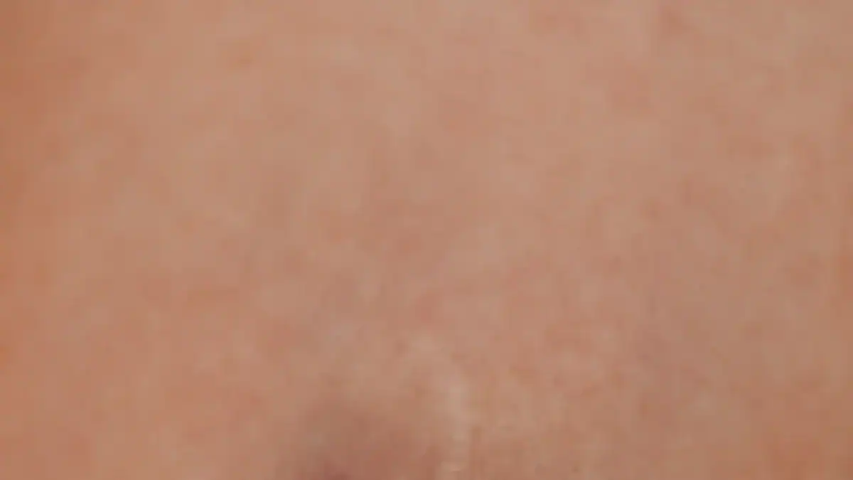 Allergic Reaction and Contact Dermatitis