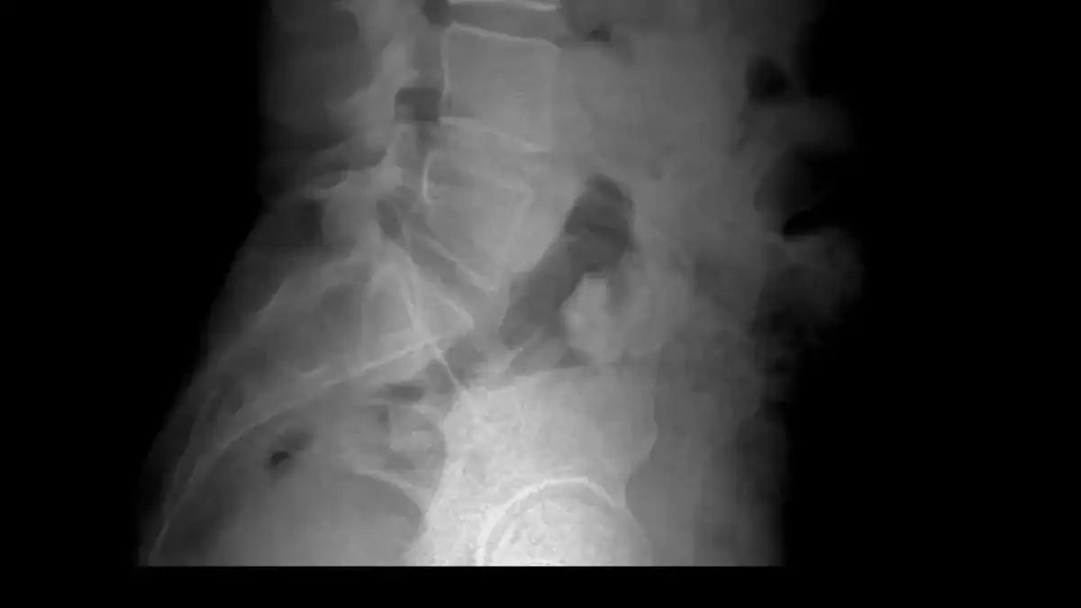Lumbar Spine and Dermatome Overview
