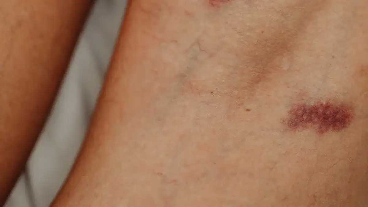 Lower Leg Redness: Causes, Symptoms, and Treatment