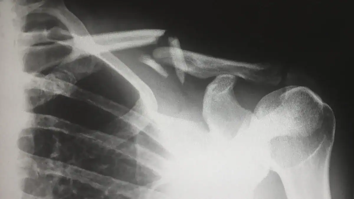 Acute Injuries Causing Arm Pain