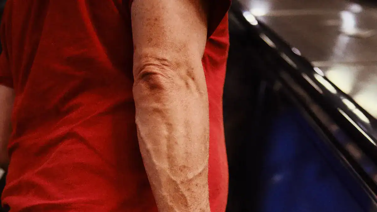 Common Causes of Bicep Twitching