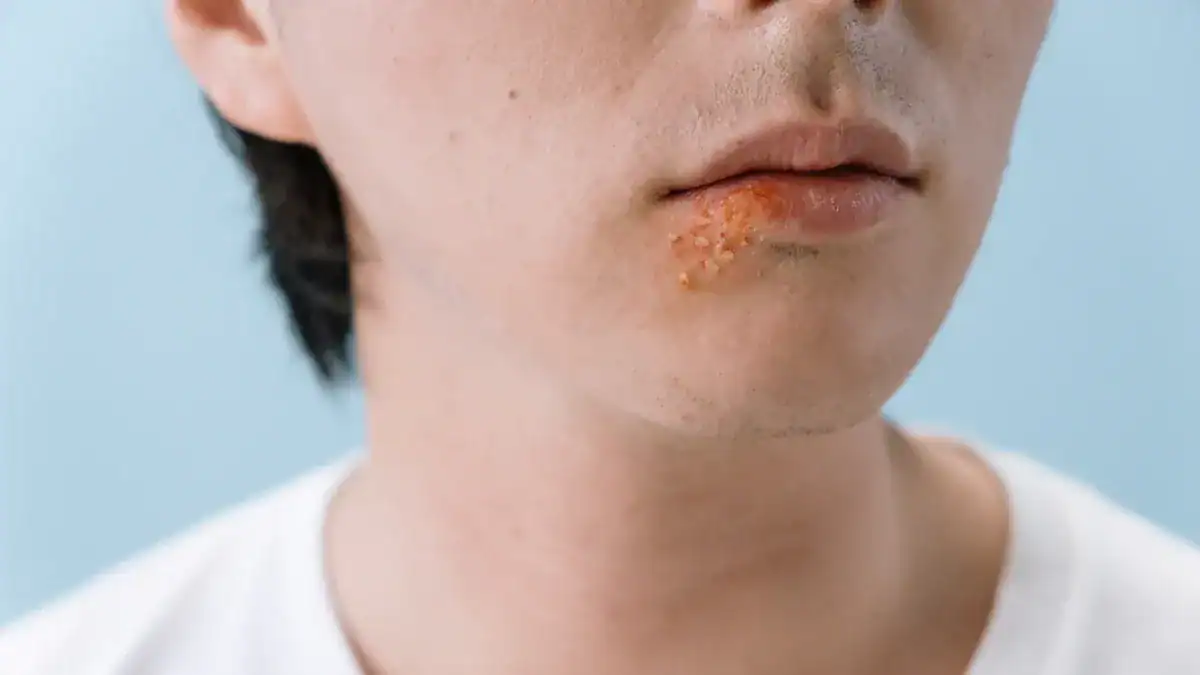 Understanding Cold Sores