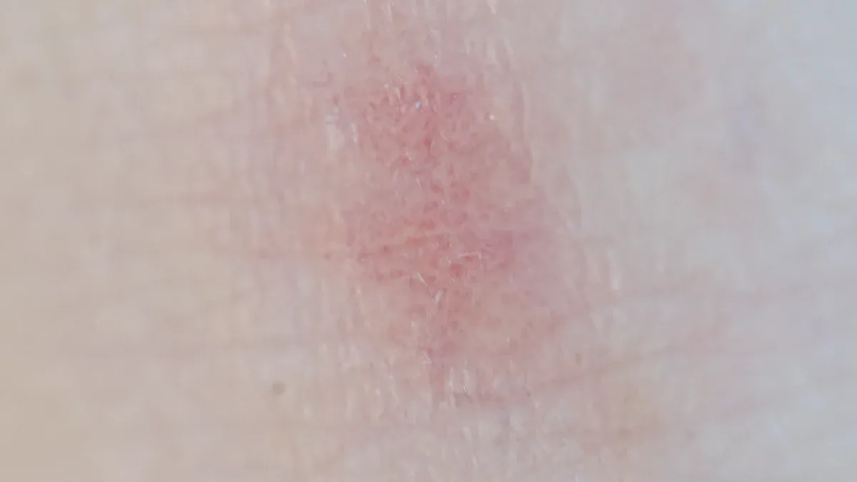 Allergic Reactions to Sudocrem