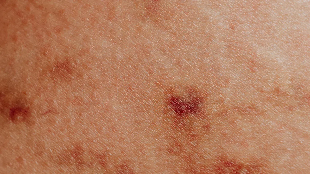 Rash Behind Knee: Causes, Relief, & Diagnosis Guide