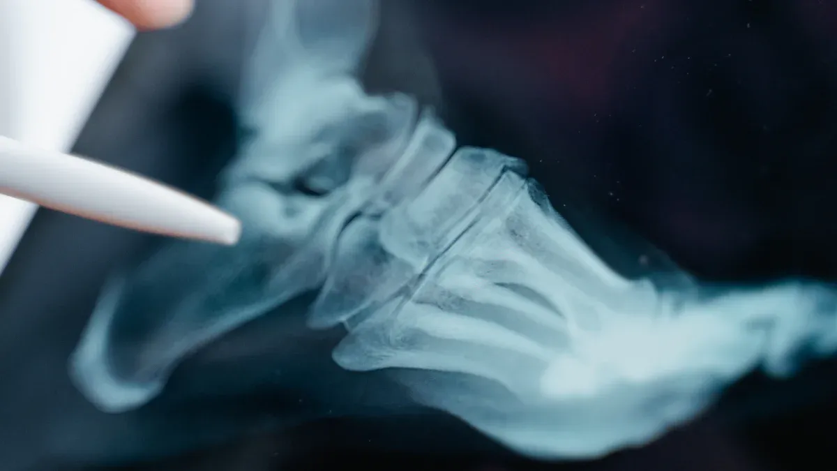 Cuboid Fracture Diagnosis
