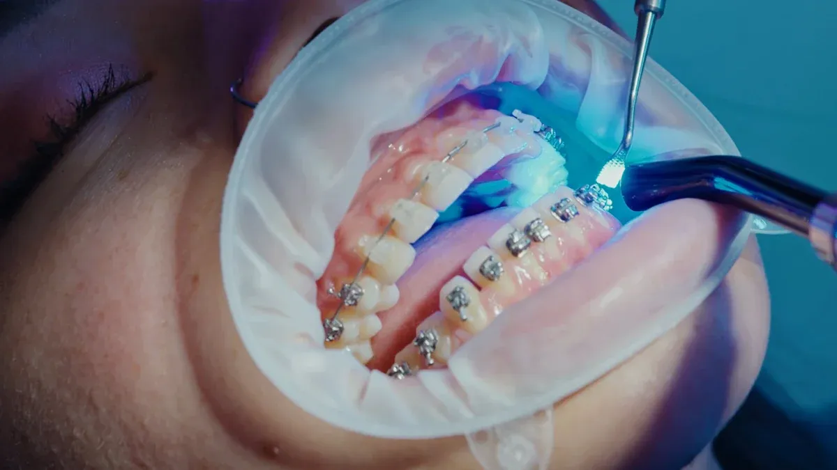 What is Zoom Teeth Whitening